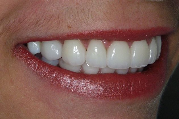 Veneers: Case 12 - After