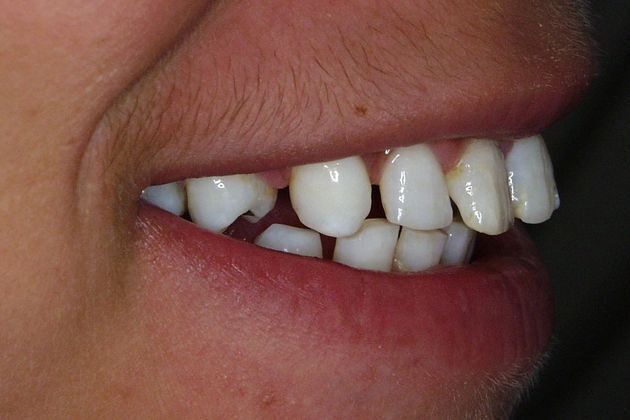 Veneers: Case 12 - Before