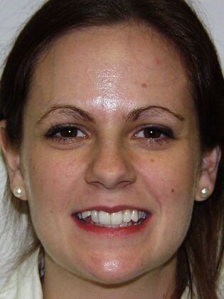 Veneers: Case 13: Molly - Before