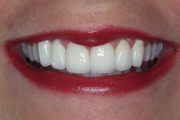 Veneers Case 13: Molly - After
