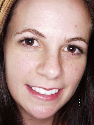 Veneers: Case 13: Molly - After