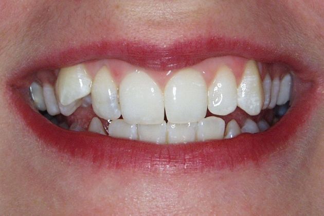 Veneers Case 13: Molly - Before