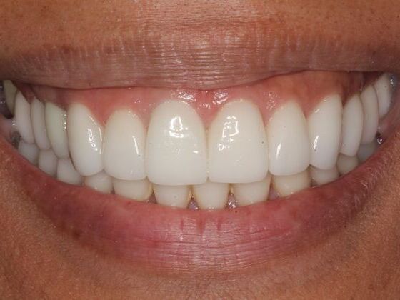 Dental Implants Case 1: Joy - After