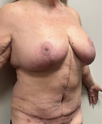 Massive Weight Loss : Case 223 - After