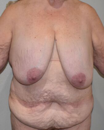 Mommy Makeover: Case 9 - Before