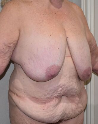Mommy Makeover: Case 9 - Before