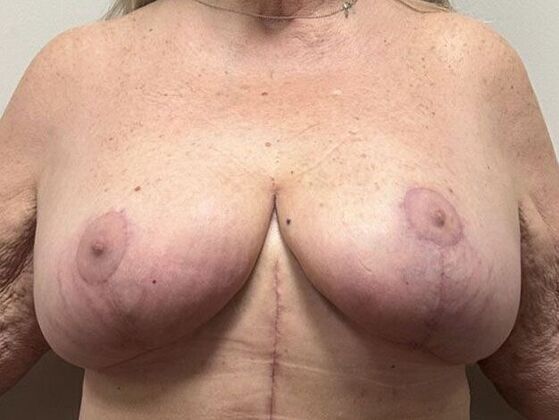 Breast Lift (Mastopexy): Case 280 - After