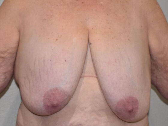 Breast Lift (Mastopexy): Case 280 - Before