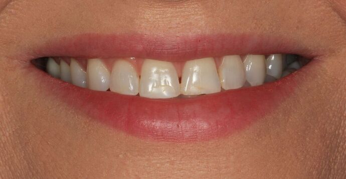 Bonding: Case 15 - Before