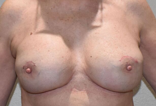 Breast Revision: Case 16 - After