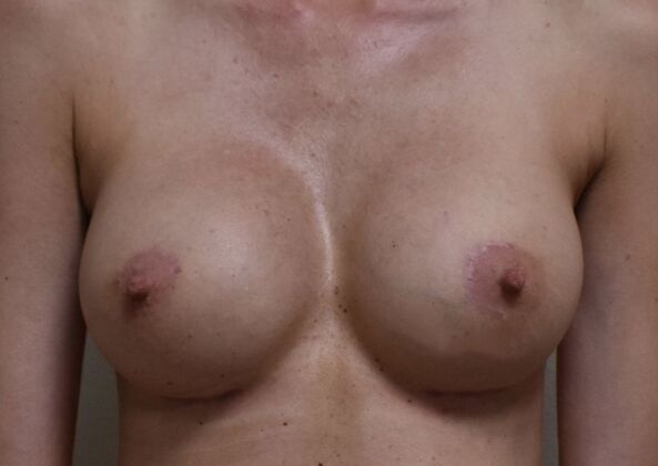 Breast Revision: Case 352 - After