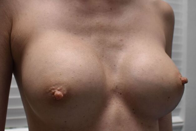 Breast Revision: Case 352 - Before