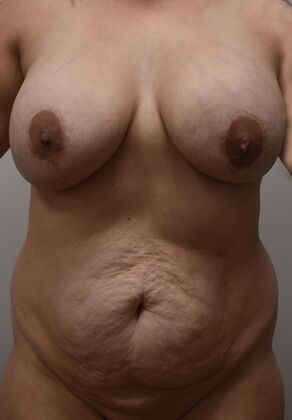 Mommy Makeover Case 386 - Before
