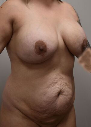 Mommy Makeover: Case 386 - Before