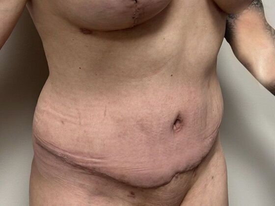 Tummy Tuck (Abdominoplasty): Case 602 - After