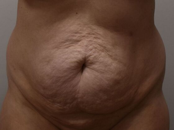 Tummy Tuck (Abdominoplasty): Case 602 - Before