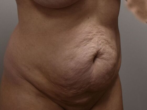 Tummy Tuck (Abdominoplasty): Case 602 - Before