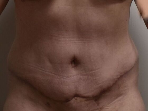 Tummy Tuck (Abdominoplasty): Case 602 - After