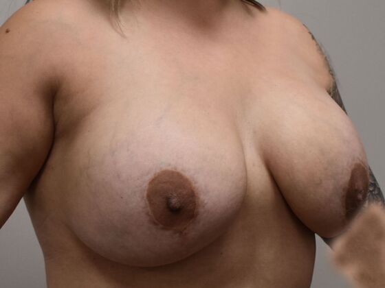 Breast Revision: Case 354 - Before