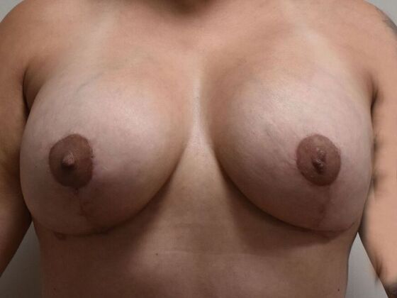 Breast Revision Case 354 - After
