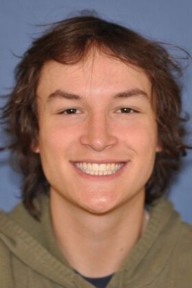 Rhinoplasty: young man with bump and breathing problem - After