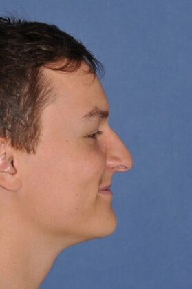Rhinoplasty: young man with bump and breathing problem - Before