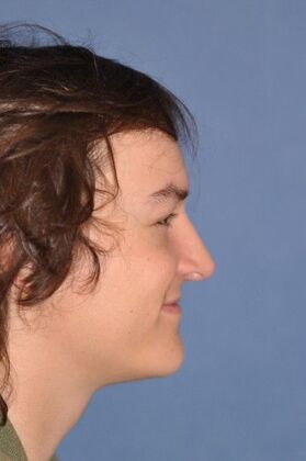 Rhinoplasty: young man with bump and breathing problem - After