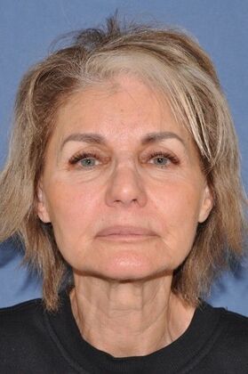 Facelift Deep Plane Face and Neck lift and Minor Rhinoplasty - Before