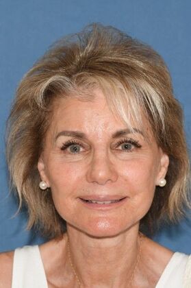 Facelift Deep Plane Face and Neck lift and Minor Rhinoplasty - After