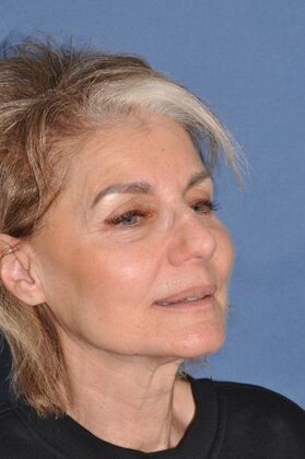 Facelift: Deep Plane Face and Neck lift and Minor Rhinoplasty - Before
