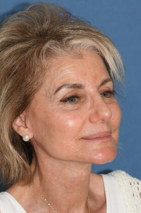 Facelift: Deep Plane Face and Neck lift and Minor Rhinoplasty - After