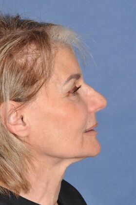 Facelift: Deep Plane Face and Neck lift and Minor Rhinoplasty - Before