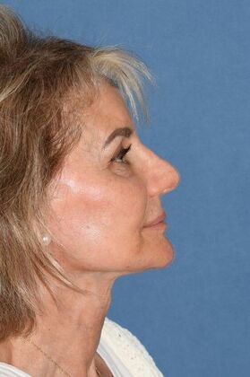 Facelift: Deep Plane Face and Neck lift and Minor Rhinoplasty - After