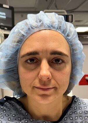 Endoscopic Browlift Young woman with asymmetric, low eyebrows and wrinkles - Before