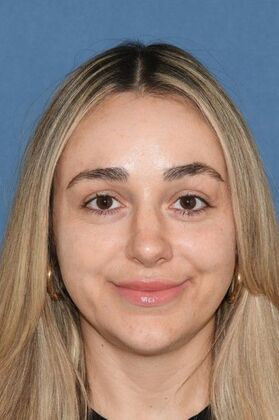 Endoscopic Browlift Young woman with asymmetric, low eyebrows and wrinkles - After