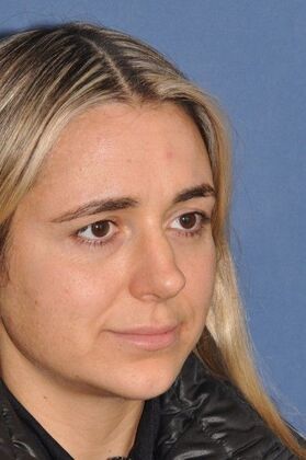 Endoscopic Browlift: Young woman with asymmetric, low eyebrows and wrinkles - Before