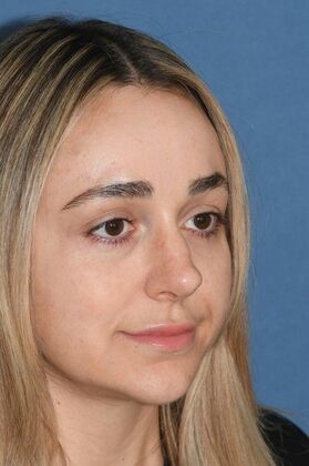 Endoscopic Browlift: Young woman with asymmetric, low eyebrows and wrinkles - After