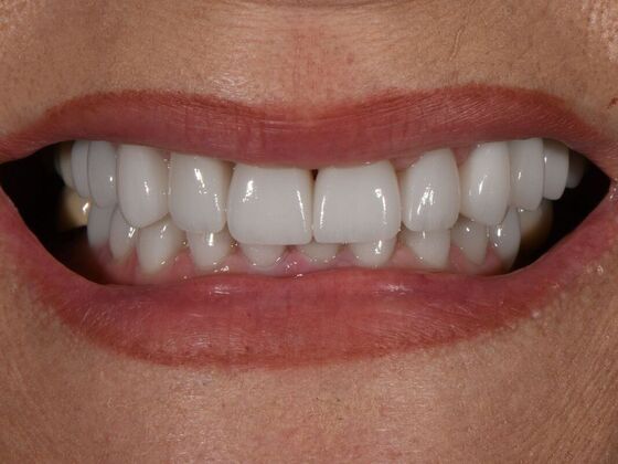 Full Smile Transformations Case 8 - After