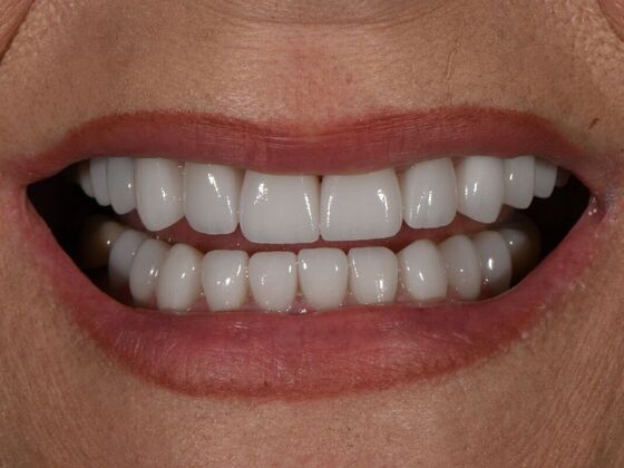 Full Smile Transformations: Case 8 - After