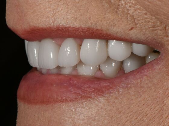 Full Smile Transformations: Case 8 - After