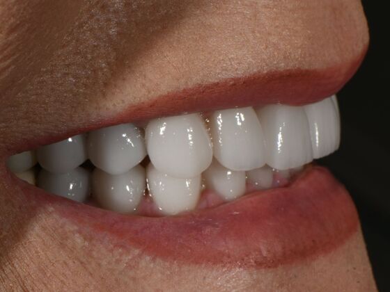 Full Smile Transformations: Case 8 - After