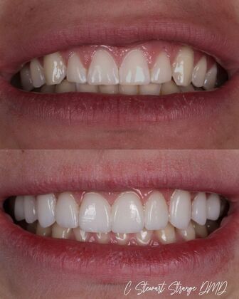 Full Smile Transformations Case 9