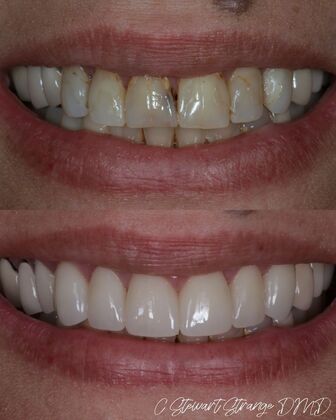 Full Smile Transformations Case 10