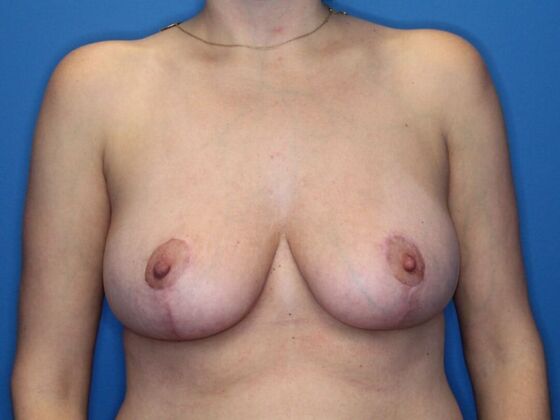 Breast Reduction Case 1 - After