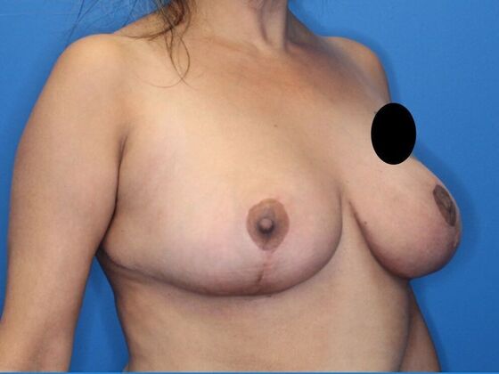 Breast Reduction: Case 2 - After