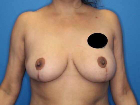 Breast Reduction Case 2 - After