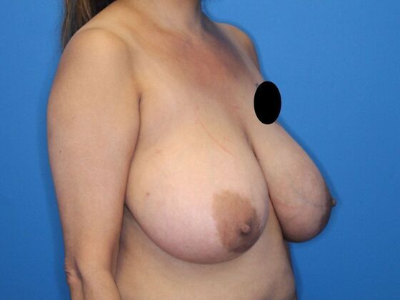 Breast Reduction: Case 2 - Before