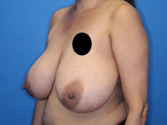 Breast Reduction: Case 2 - Before