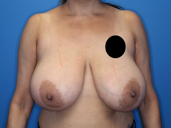 Breast Reduction Case 2 - Before