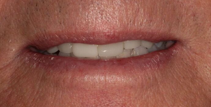 Invisalign Case 23 - Before